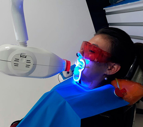 Blanqueamiento dental Blanqueamiento Dental