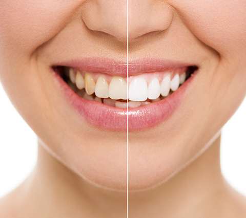 Blanqueamiento dental en Bogot, antes y despus del tratamiento