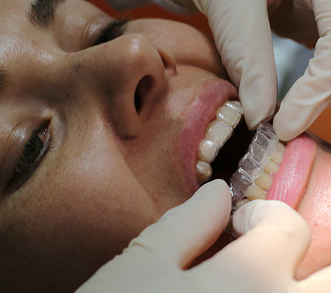 Ortodoncia invisible en Bogotá, paciente recibe tratamiento en dientes
