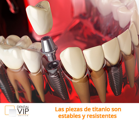 Imagen digital de implantes dentales en Bogot