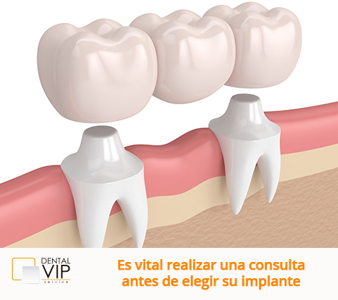 Ejemplo de implantes dentales en Bogotá 