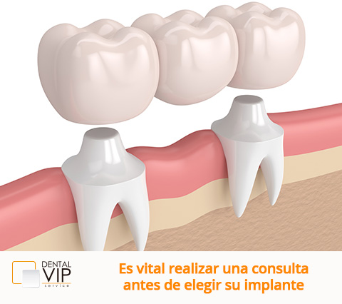 Ejemplo de implantes dentales en Bogot 