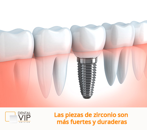 Implantes dentales en Bogot para adultos